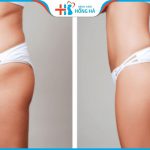 Cấy mỡ hõm mông – Vòng 3 căng tràn sexy đầy tự nhiên