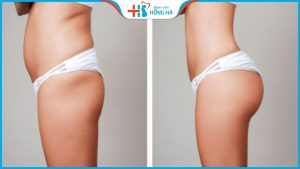 Cấy mỡ hõm mông – Vòng 3 căng tràn sexy đầy tự nhiên