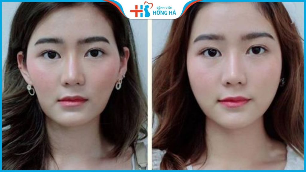 Cấy mỡ mặt trẻ hóa da có an toàn và lâu dài không?