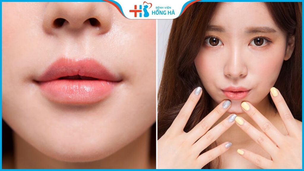 Cấy mỡ môi căng mọng, mềm mại đẹp tự nhiên chỉ sau 1 lần thực hiện