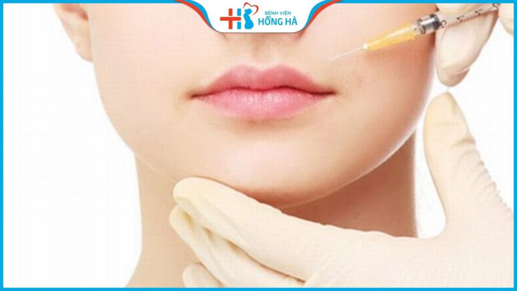 Cấy mỡ rãnh mũi má làm khuôn mặt đầy đặn tự nhiên,xóa mờ nếp nhăn
