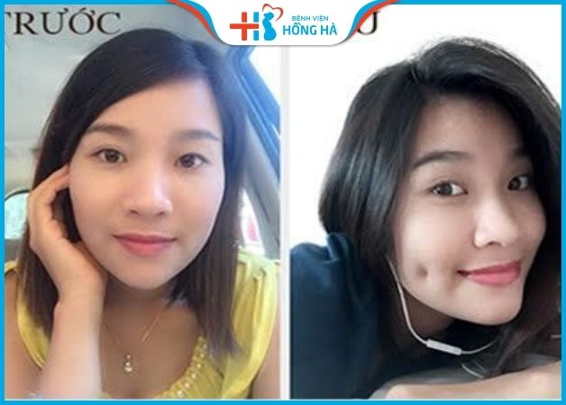Hình ảnh trước và sau khi làm lúm đồng tiền tại BV Hồng Hà