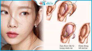 Lấy sụn tai nâng mũi có đau không – Bác sĩ BV Hồng Hà giải đáp
