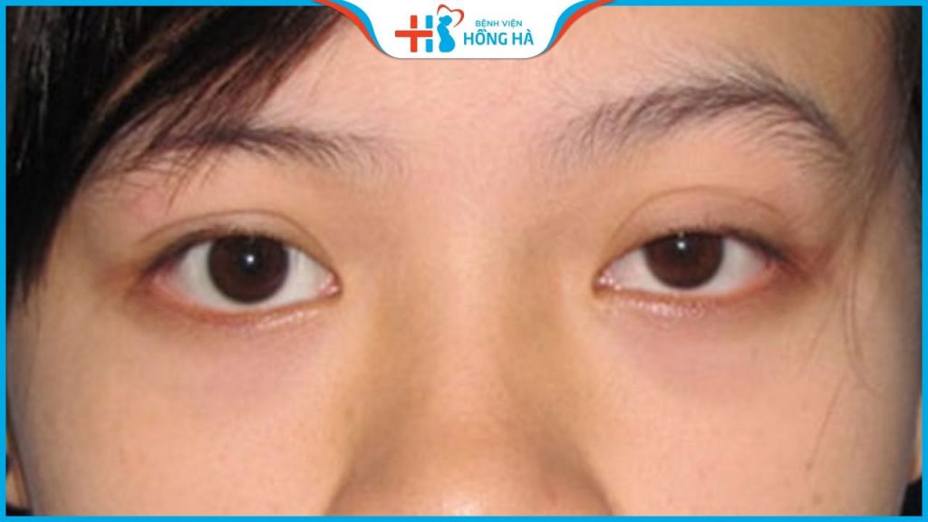 Mắt to mắt nhỏ: Nguyên nhân, ảnh hưởng và cách khắc phục triệt để