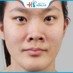 Mũi hếch: Cách nhận biết, ý nghĩa tướng số và cách khắc phục hiệu quả