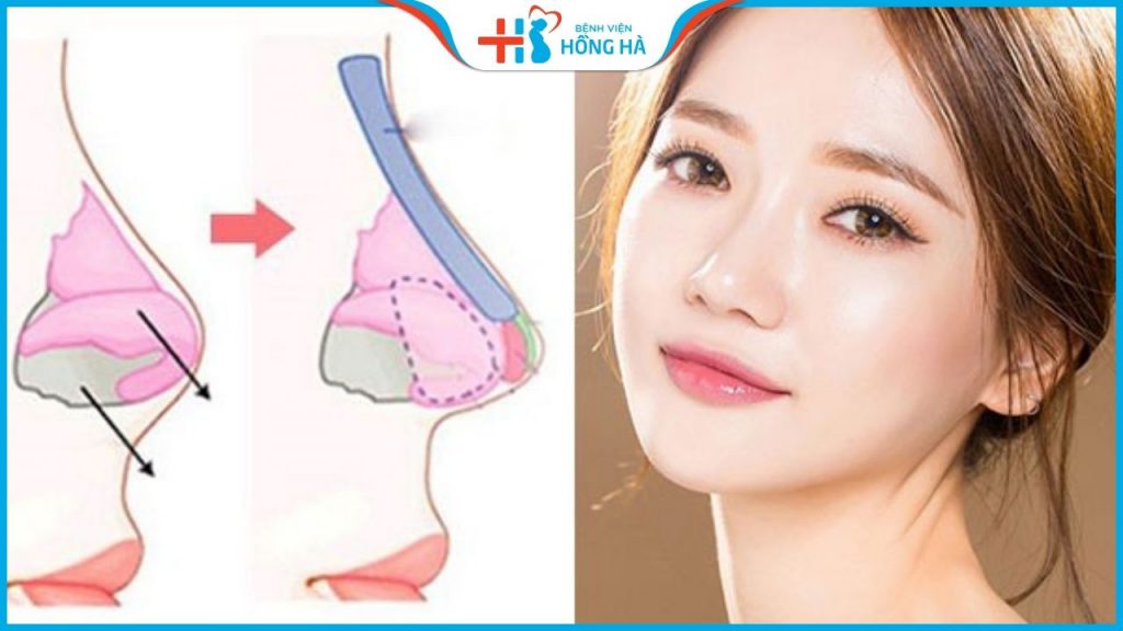 Nâng mũi bọc sụn 2 lớp là gì? Khác gì so với nâng mũi thông thường?