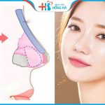 Nâng mũi bọc sụn 2 lớp là gì? Khác gì so với nâng mũi thông thường?
