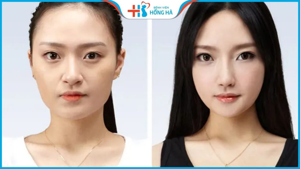 Bác sĩ thẩm mỹ giải đáp : Nâng mũi rồi có thu nhỏ đầu mũi được không ?