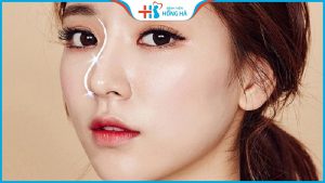 Nâng mũi s line có đau không – chuyên gia thẩm mỹ BV Hồng Hà giải đáp