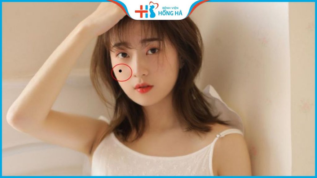 Vị trí nốt ruồi ở má nam và nữ nói lên điều gì? Phúc hay họa?