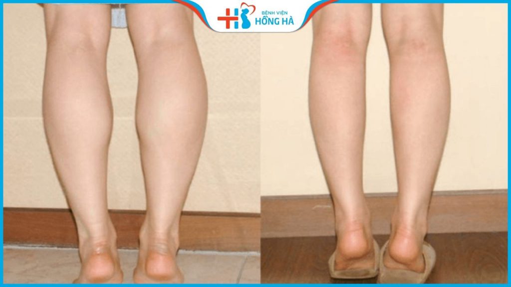 Phẫu thuật thu gọn cơ bắp chân sau 60 phút- Làm ở đâu tốt? Lưu ý