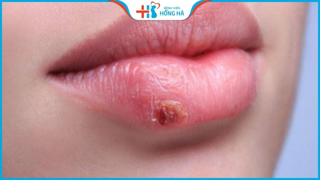 Sửa sẹo môi lâu năm – Giải pháp tái sinh môi đẹp nhanh chóng hiệu quả