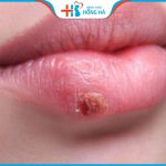 Sửa sẹo môi lâu năm – Giải pháp tái sinh môi đẹp nhanh chóng hiệu quả