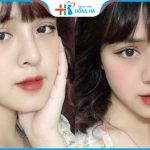 Thẩm mỹ thu nhỏ cánh mũi như thế nào? Giá bao nhiêu? Làm ở đâu đẹp?