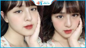 Thẩm mỹ thu nhỏ cánh mũi như thế nào? Giá bao nhiêu? Làm ở đâu đẹp?