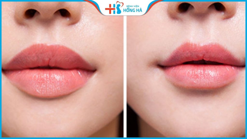 Tạo má lúm đồng tiền Cutie xinh như ý chỉ sau 10 phút