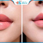 Tạo má lúm đồng tiền Cutie xinh như ý chỉ sau 10 phút