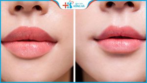 Thu mỏng môi – Cải thiện khẩu tướng, cho môi xinh quyến rũ