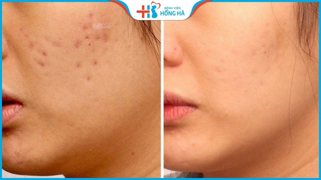 Trị thâm sẹo rỗ lâu năm có khó không? 4 Yếu tố ảnh hưởng