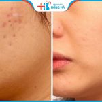 Trị thâm sẹo rỗ lâu năm có khó không? 4 Yếu tố ảnh hưởng