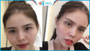 Địa chỉ cắt mí đẹp ở Hà Nội và Tp. Hồ Chí Minh – BV Hồng Hà