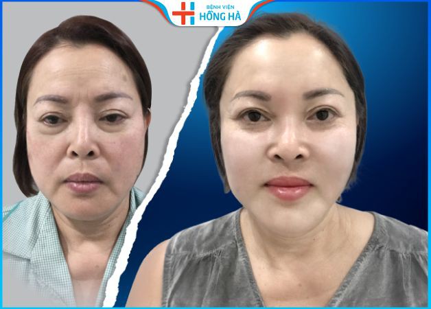 Chị Mai hài lòng về dịch vụ căng da mặt ở Hà Nội tại BV Hồng Hà