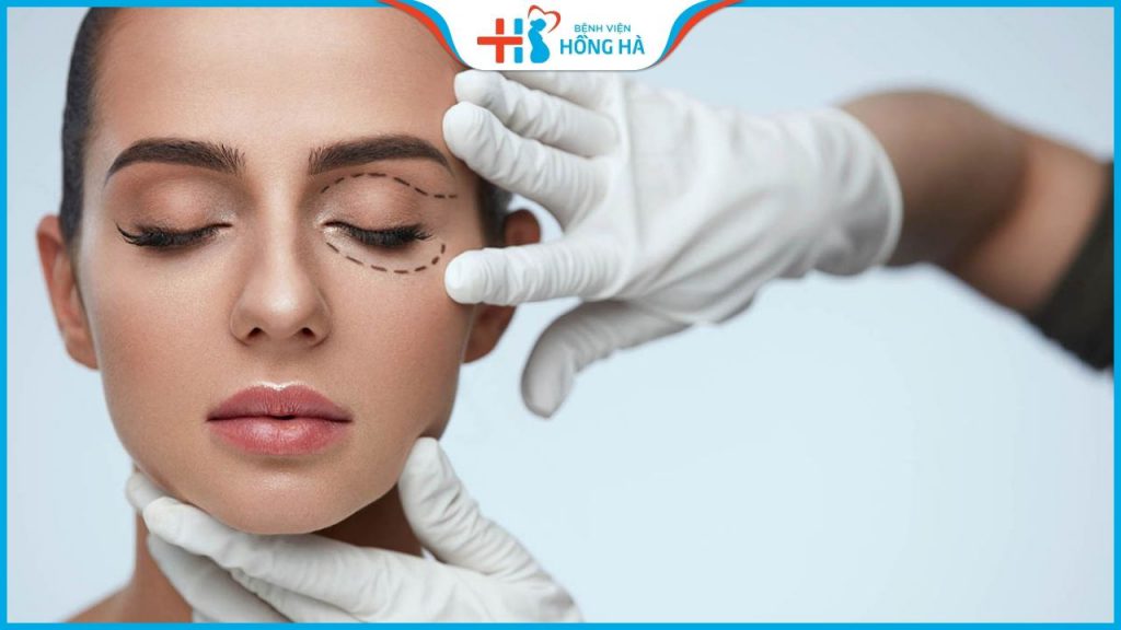 Cắt mí bao lâu thì đẹp, hết sưng – Bác sĩ thẩm mỹ BV Hồng Hà giải đáp