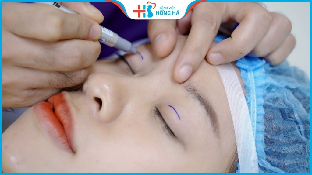 Cắt mí bao nhiêu tiền? 4 yếu tố ảnh hưởng đến giá cắt mí