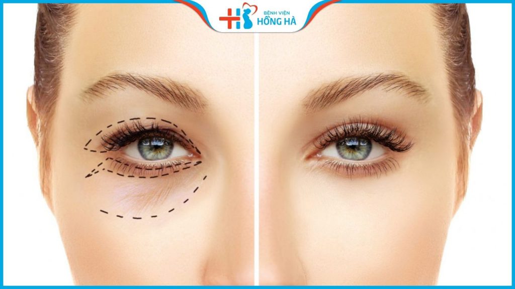 Cắt mí Thai Eyelid: Giải pháp khắc phục triệt để khuyết điểm của mắt