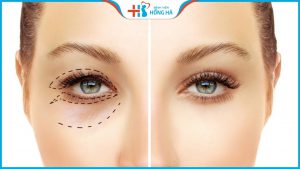 Cắt mí Thai Eyelid: Giải pháp khắc phục triệt để khuyết điểm của mắt