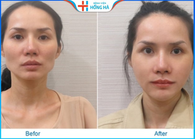 hình ảnh trước và sau khi cấy mỡ của khách hàng tại BV Hồng Hà