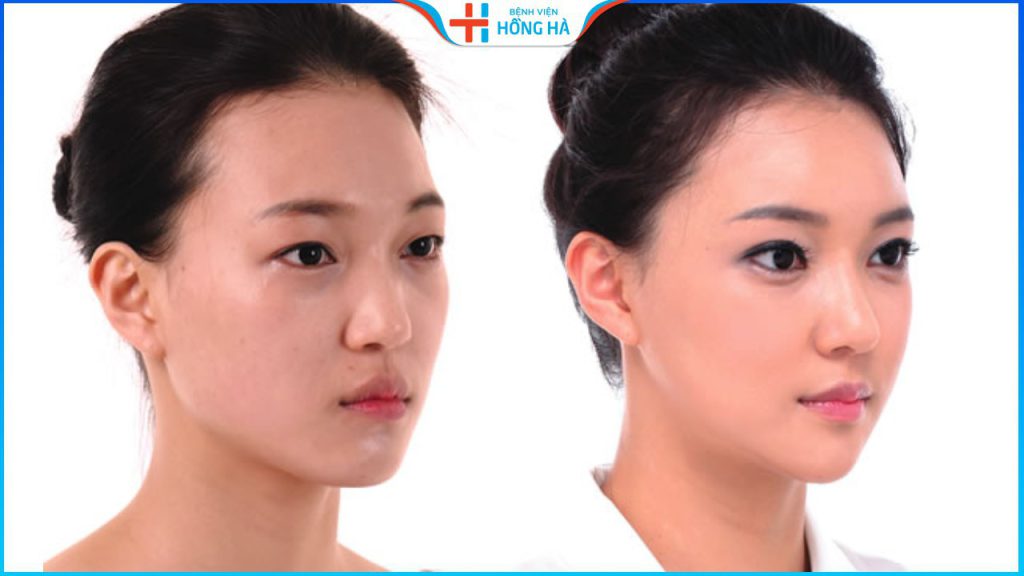 Cấy mỡ má bao nhiêu tiền? Cách tiết kiệm chi phí làm đầy má