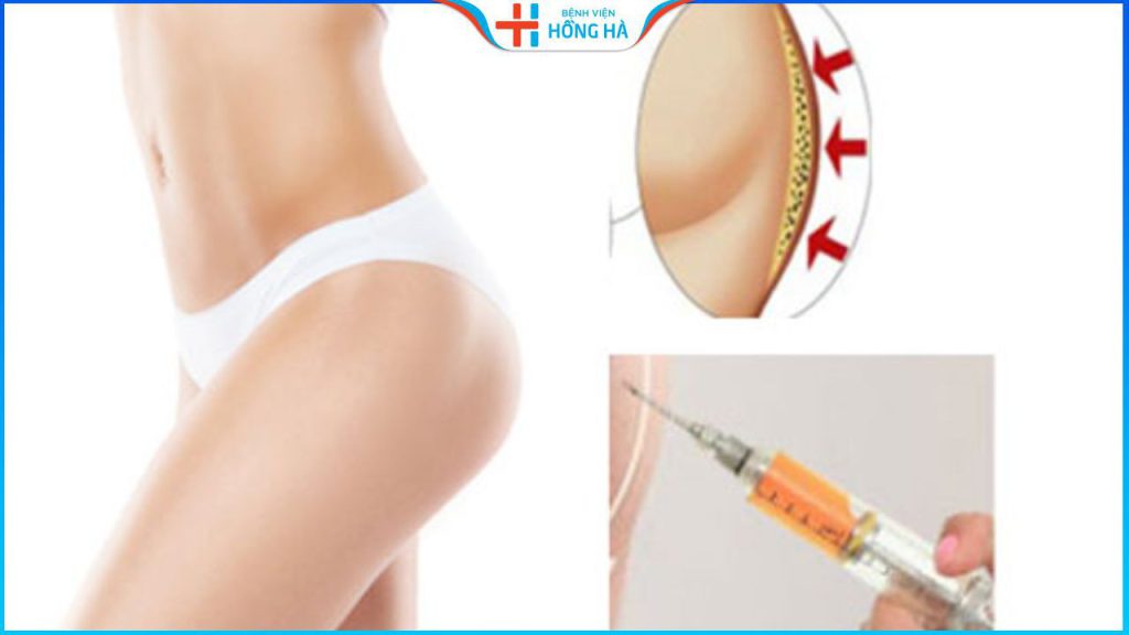 Cấy mỡ mông có an toàn không? Hiệu quả giữ được bao lâu?