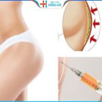 Cấy mỡ mông có an toàn không? Hiệu quả giữ được bao lâu?