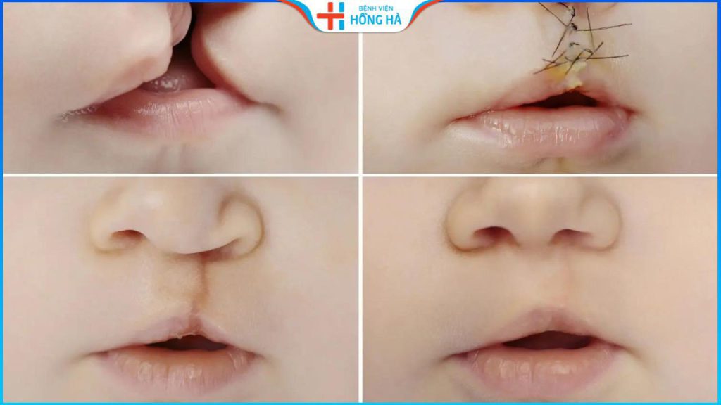 Chi phí phẫu thuật sứt môi hở hàm ếch có được BHYT chi trả không?