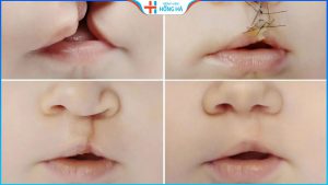 Chi phí phẫu thuật sứt môi hở hàm ếch có được BHYT chi trả không?