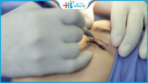 Địa chỉ bấm mí đẹp tự nhiên, an toàn tại Hà Nội, TP. Hồ Chí Minh