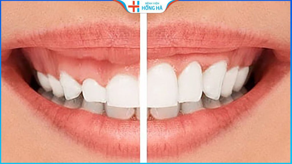 Điều trị cười hở lợi giá bao nhiêu? Nên chữa cười hở lợi giá rẻ không?