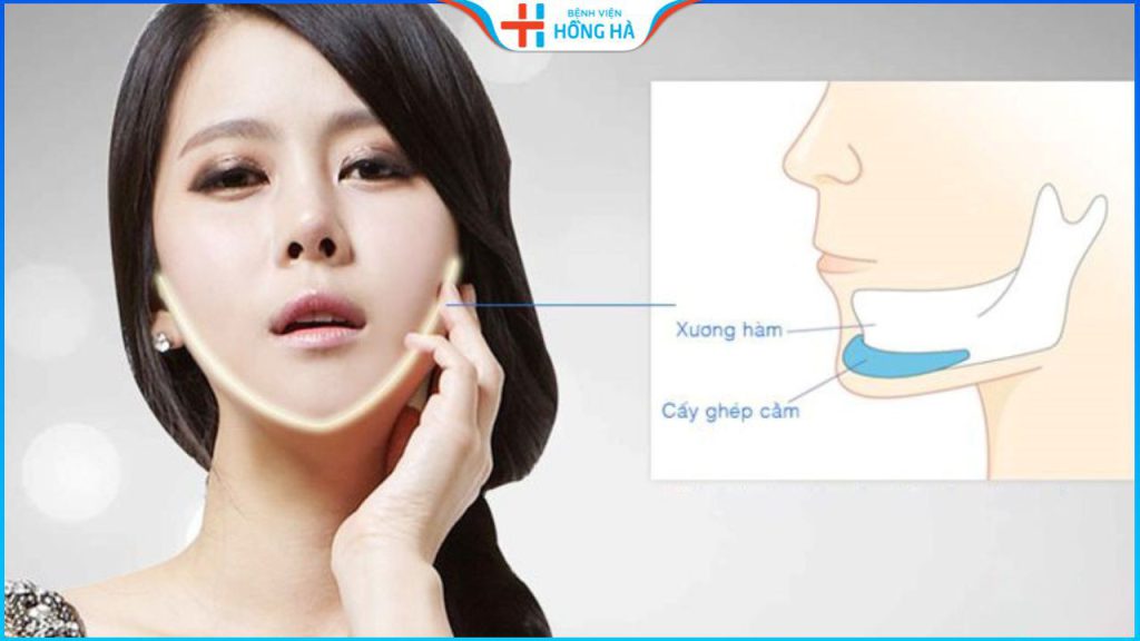 Độn cằm giá bao nhiêu? Bí quyết tiết kiệm chi phí độn cằm