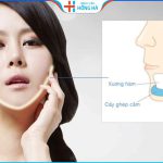 Độn cằm giá bao nhiêu? Bí quyết tiết kiệm chi phí độn cằm