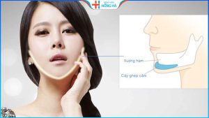 Độn cằm giá bao nhiêu? Bí quyết tiết kiệm chi phí độn cằm