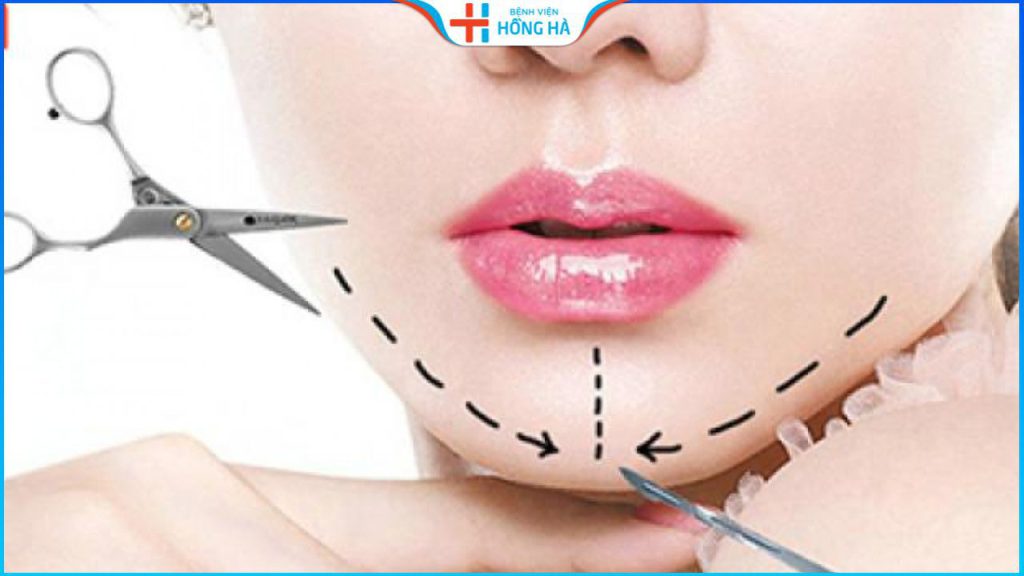 Độn cằm ở đâu đẹp? Gợi ý địa chỉ độn cằm đẹp, uy tín tại Hà Nội/HCM