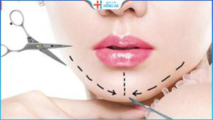 Độn cằm ở đâu đẹp? Gợi ý địa chỉ độn cằm đẹp, uy tín tại Hà Nội/HCM