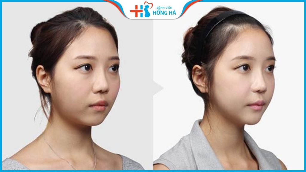 Độn trán có nguy hiểm không? Ưu điểm khi độn trán tại Hồng Hà