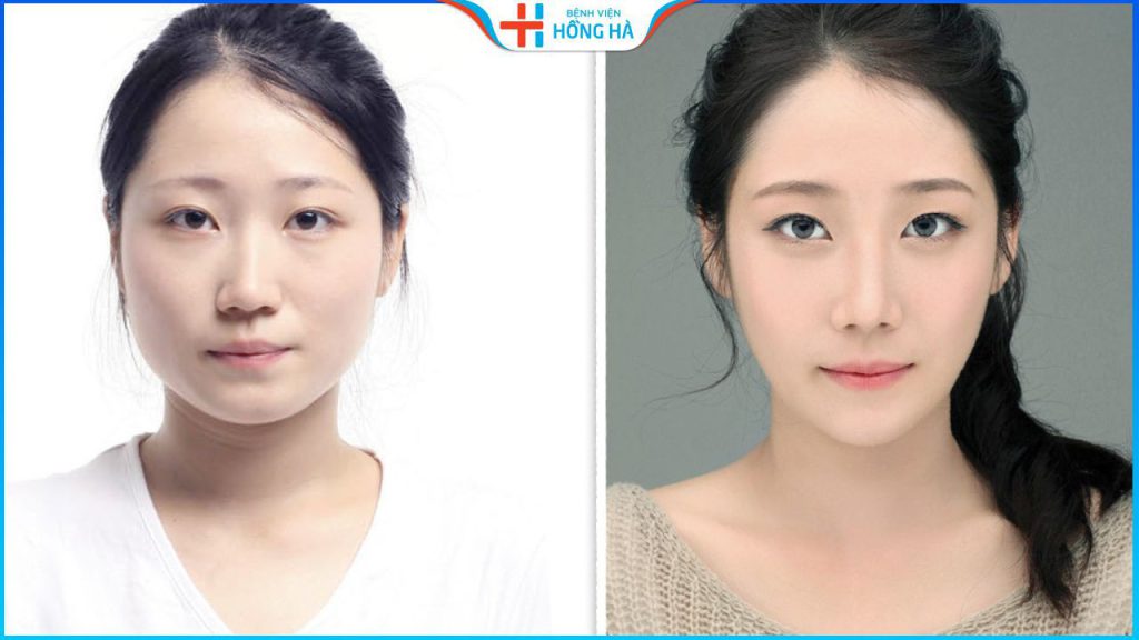 Hạ gò má giá bao nhiêu? 6 yếu tố quyết định đến giá thẩm mỹ hạ gò má