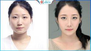 Hạ gò má giá bao nhiêu? 6 yếu tố quyết định đến giá thẩm mỹ hạ gò má