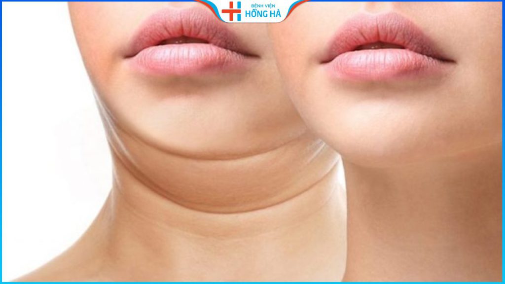Hút mỡ nọng cằm giá bao nhiêu? Ở đâu tốt, an toàn?