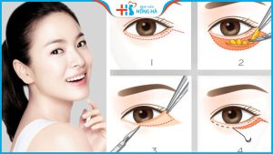 Lấy mỡ bọng mắt có đau không? 4 Cách ngăn ngừa tái phát