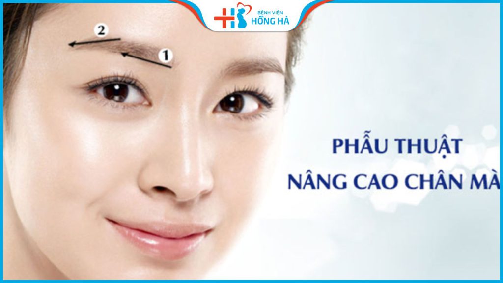 Nâng cung mày giá bao nhiêu tiền? Cách nhận ưu đãi tại BV Hồng Hà