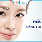 Nâng cung mày giá bao nhiêu tiền? Cách nhận ưu đãi tại BV Hồng Hà